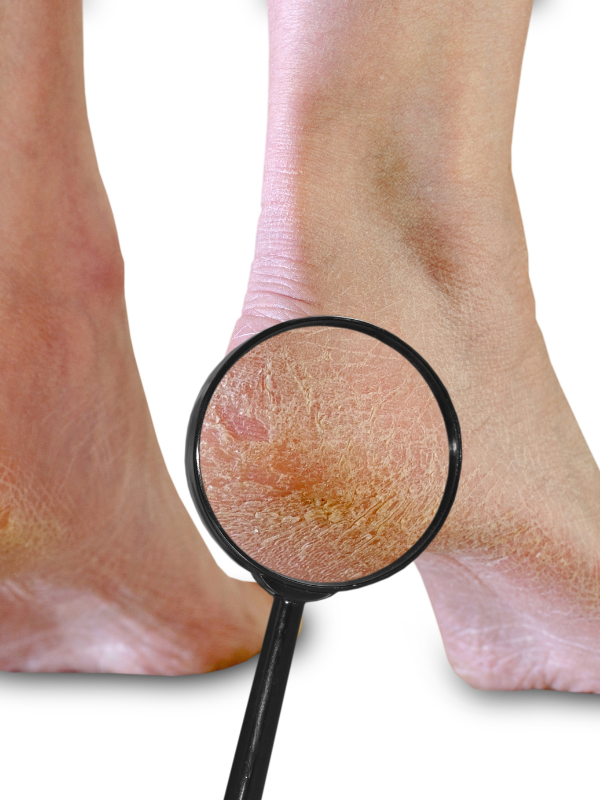 Why do I get Dry skin and cracked heels? - Profoot